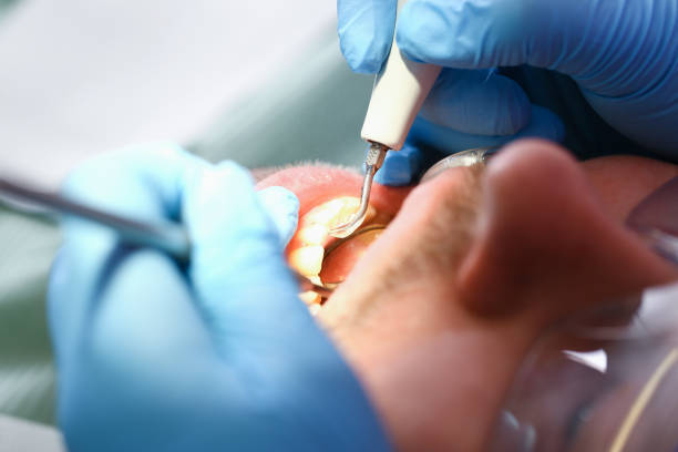 Best Emergency Tooth Extraction in Beverly, MA